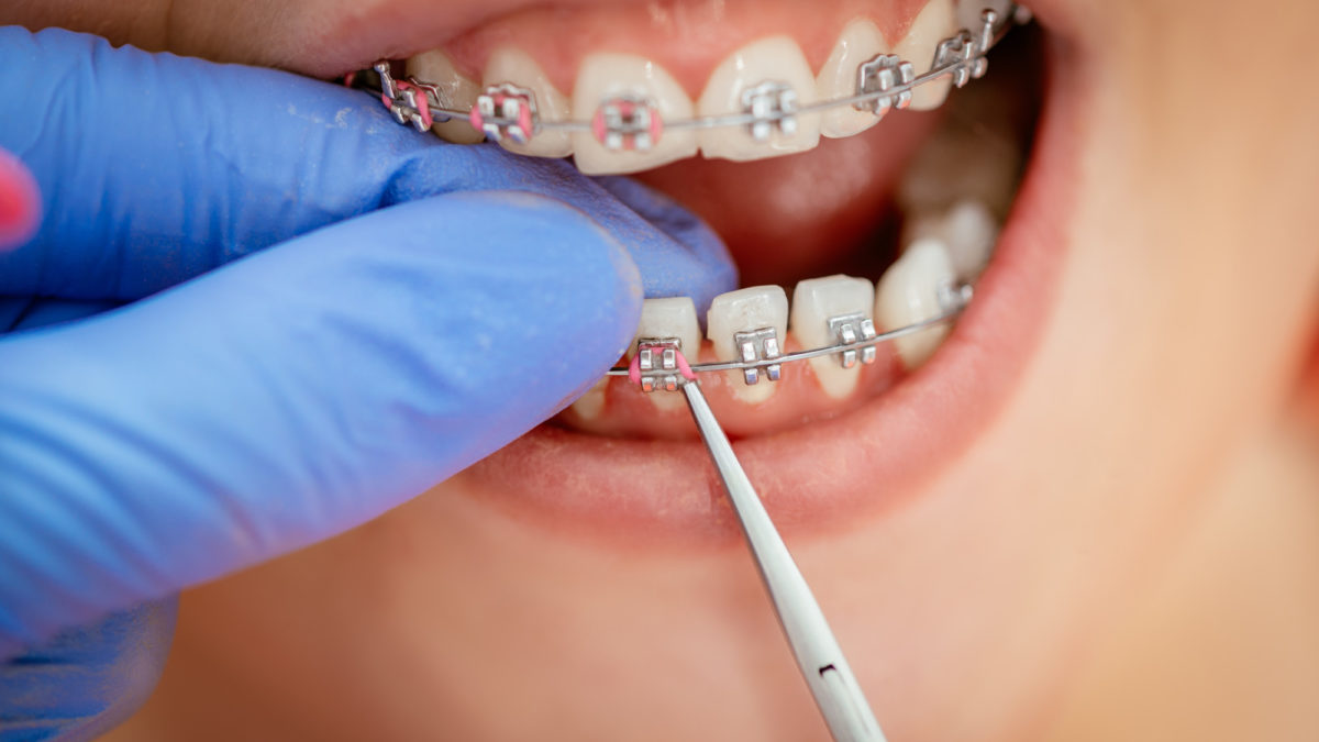 Have A Thorough Conversation With Your Orthodontist Before Your Treatment