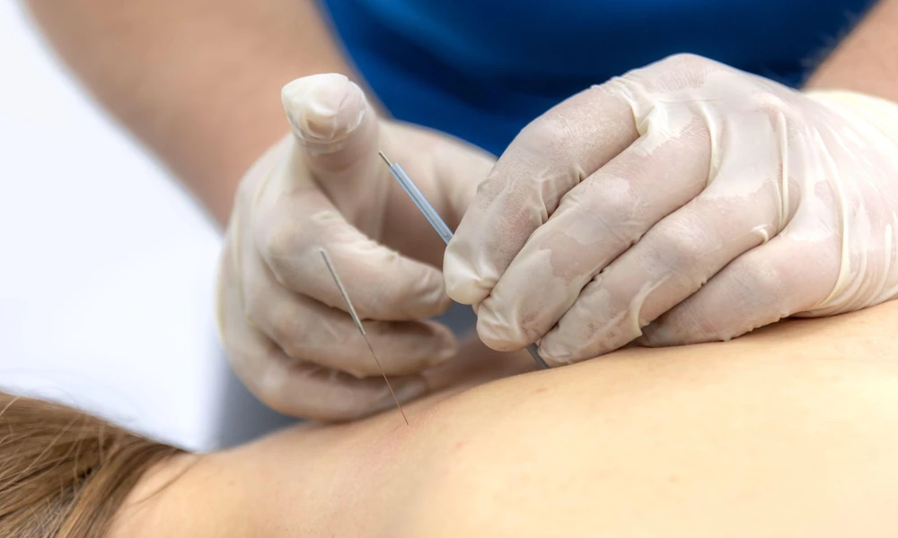 Common Conditions That May Benefit from Dry Needling Treatment
